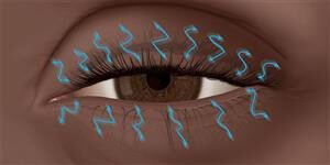 Image courtesy of aao.org Lid twitch or flutter