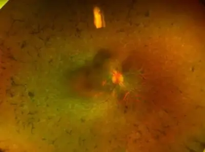 Peripheral pigmented bone spicules